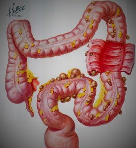 Diverticuloza și diverticulita în uzi (prelegere pe diagnostician)