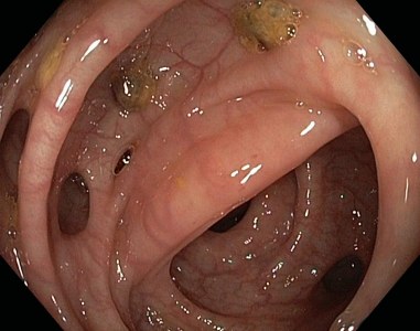 Diverticuloza și diverticulita în uzi (prelegere pe diagnostician)