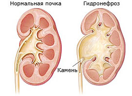 Hidronefroza bilaterală a rinichilor atunci când se întâmplă și ce amenință