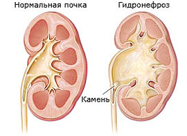 Двосторонній гідронефроз нирок коли він буває і чим загрожує