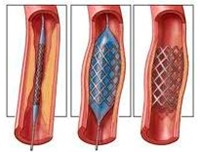 Chirurgie vasculară endovasculară - Clinica a Institutului de Limfologie