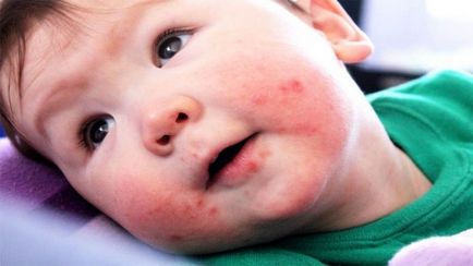 Infecția cu enterovirus la simptomele și tratamentul copiilor