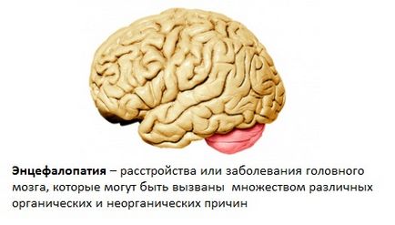 Енцефалопатія головного мозку - що це таке