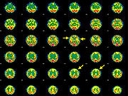 Hashimoto-encephalopathia - egy