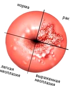 A méhnyak erózió okai, tünetei, kezelése