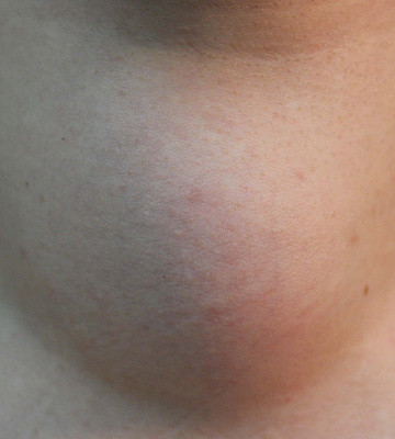 Euthyroid goiter (multinodular, categoric) 1, 2 grade de simptome și de tratament, on-line sanatos