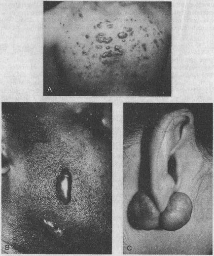 Tumori ale pielii fibroase - enciclopedie medicală