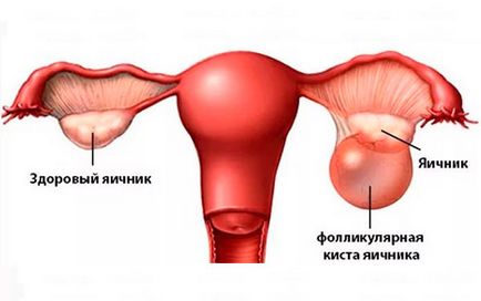 Chistul folicular are primele semne, simptome, consecințe