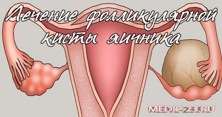 Folosirea chisturilor ovariene foliculare și simptomele debutului