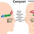 sinusitis tünetei