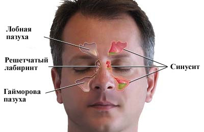 Sinusurile maxilare sunt dispuse și cum arată