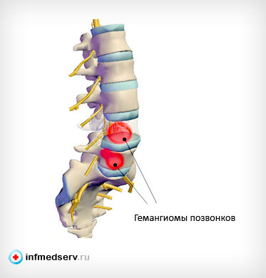 Tratamentul spinal cu hemangiom