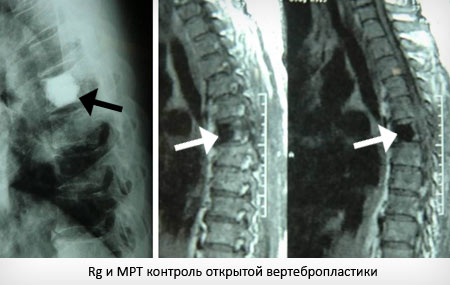 Tratamentul spinal cu hemangiom