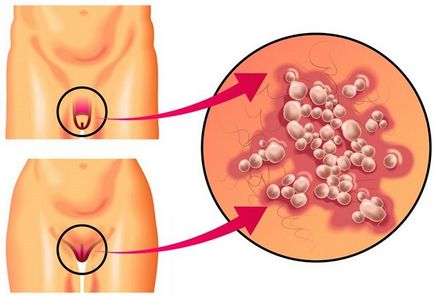 Herpes genital la bărbați