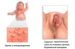 Герпес у новонародженого симптоми, лікування і наслідки (фото і відео)