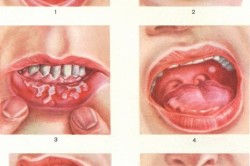 Herpes tünetek az újszülött, a kezelés és következményei (fotó és videó) (baby és az anya) Herpes tünetek az újszülött, és a kezelés hatásai (fotók és videó)