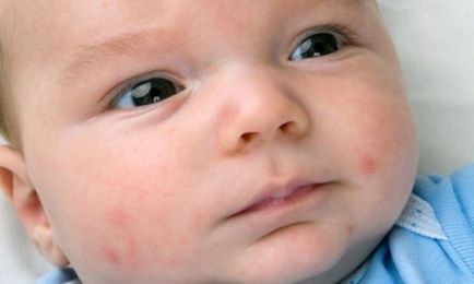 Herpesul într-un simptom nou-născut, tratament și consecințe (fotografie și video)