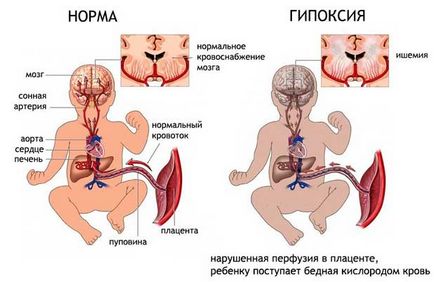 Magzati hypoxia okai és következményei a gyermek jövője (hipoxia) Magzati hypoxia okai és következményei a gyermek jövője