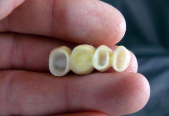 Imitatorii de dinți din zirconiu de ce acest material a învățat un astfel de succes în implantare