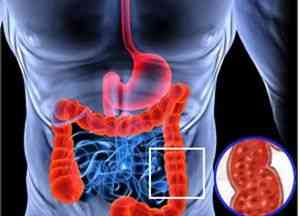 Boli infecțioase ale intestinului - boli intestinale -if () - endif - catalog de articole - proctologie