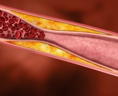 Accident vascular cerebral și alcool sunt compatibile și puteți bea