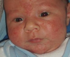 Hogyan kell kezelni streptococcus impetigo gyermekek