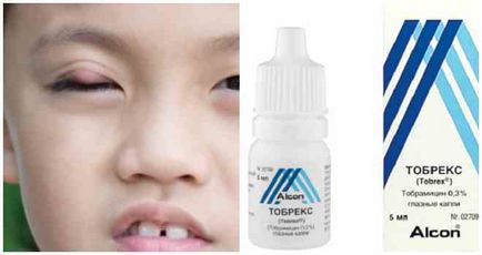 Як потрібно лікувати ячмінь на оці у дитини