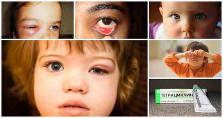 Як потрібно лікувати ячмінь на оці у дитини