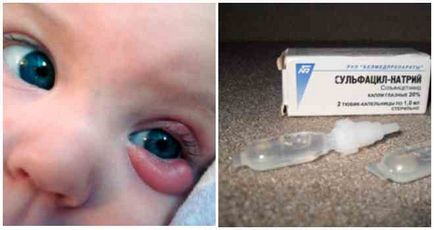 Cum să tratați orzul pe ochiul unui copil