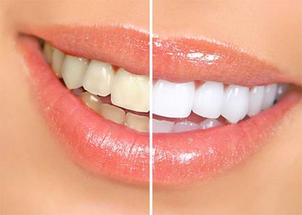 Cum să vă albiți dinții cu rețete de sodă acasă