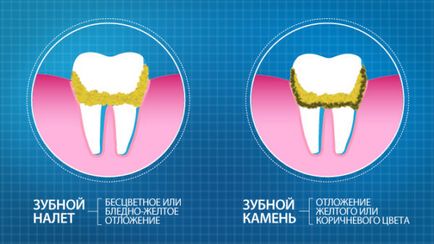 Як почистити зубний камінь в домашніх умовах думки експертів