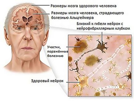 Як запобігти хворобі альгеймера