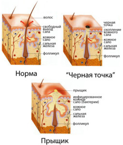 Cum este diagnosticul de acnee, tratament și prevenire