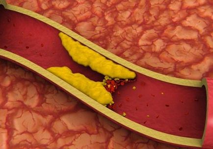 Як регулювати рівень холестерину в крові за допомогою натуральних засобів крок до здоров'я