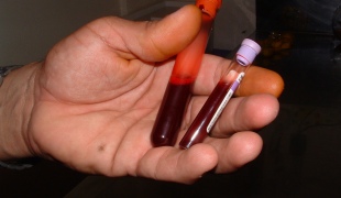 Як зменшити тромбоцити в крові