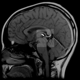 Кіста головного мозку симптоми і лікування, наслідки, фото