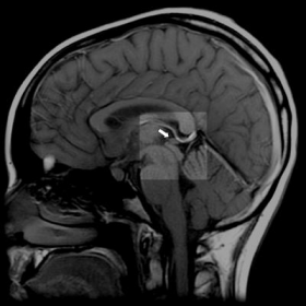 Cistul simptomelor cerebrale și de tratament, efecte, fotografie