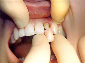 Коронки на зуби види, установка і фото
