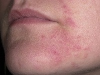 Крем і мазь від себорейного дерматиту на обличчі