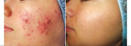 Tratamentul laser al acneei