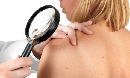 Лікування базаліоми шкіри