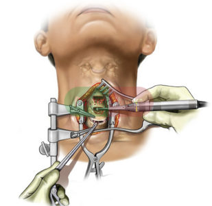 Tratamentul herniei coloanei vertebrale cervicale operative și non-chirurgicale