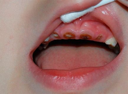 Tratamentul cariilor dentare la copiii mici