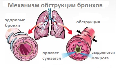 Лікування обструктивного бронхіту у дітей в домашніх умовах