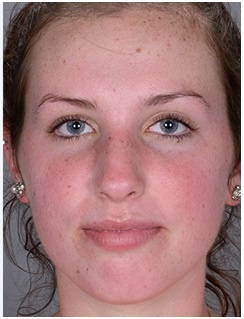 Лікування підшкірних прищів на обличчі, лобі, щоках, підборідді - що це таке, ціни, фото до і після,