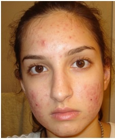 Tratamentul acneei subcutanate pe față, pe frunte, pe obraji, pe bărbie - ceea ce este, prețurile, fotografiile înainte și după,