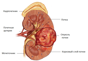 Tratamentul cu chimioterapie după îndepărtarea rinichilor