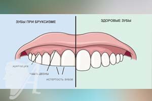 Лікування зубів у дітей з ДЦП в москві