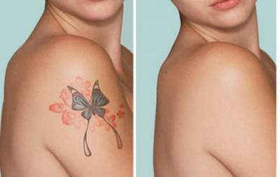Legnépszerűbb módszerek eltávolítása tetoválás a test - gamersnew - hírek a játékosok
