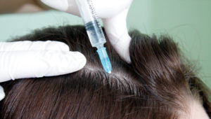 Мезотерапія для росту волосся голови як проводиться процедура, який ефект після